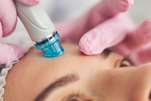 Limpieza facial con punta de diamante